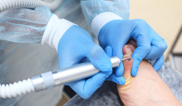 How Effective Is Okita Nail Fungus Light for Persistent Nail Infections?